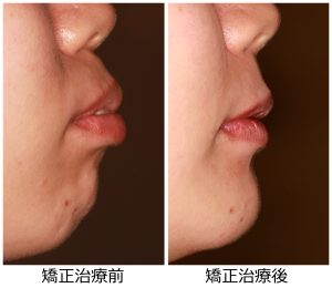 出っ歯治療前後