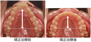 出っ歯治療前後