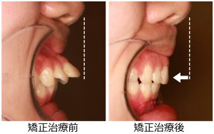 出っ歯治療前後