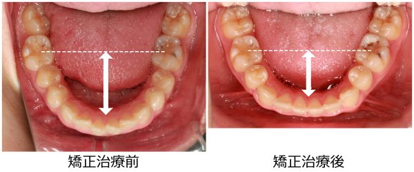 出っ歯治療前後