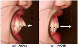 出っ歯治療前後