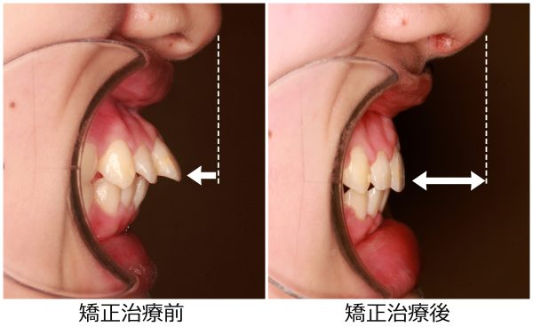 出っ歯治療前後