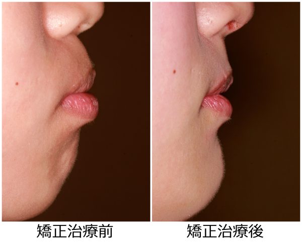 出っ歯治療前後