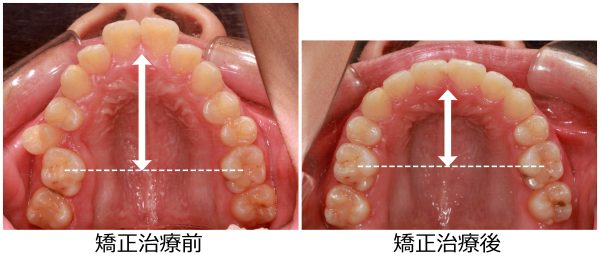 出っ歯治療前後
