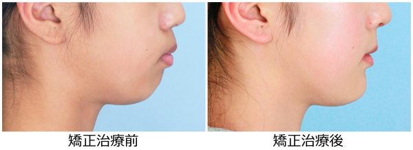 出っ歯治療前後