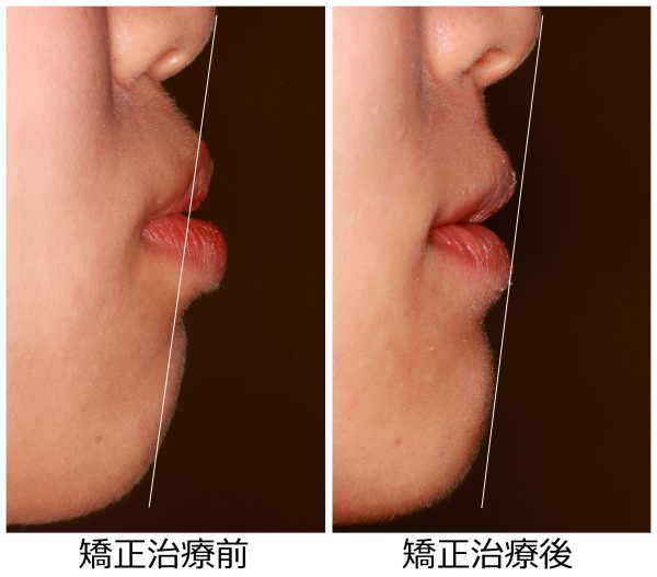 出っ歯治療前後