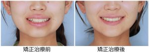 出っ歯治療後