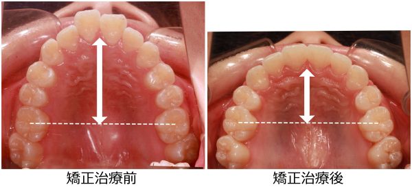 出っ歯治療前後