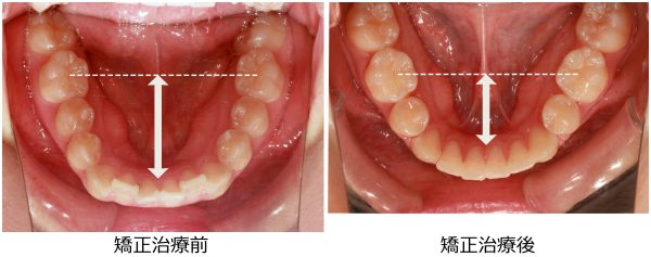 出っ歯治療前後