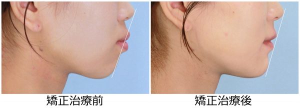 口ゴボ治療前後