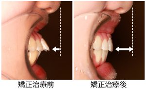 出っ歯治療前後