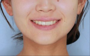 出っ歯治療後
