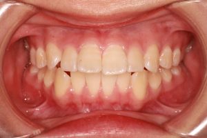 出っ歯治療前