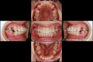 出っ歯治療前後