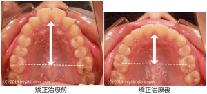 出っ歯治療前後