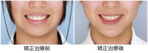 出っ歯治療前後