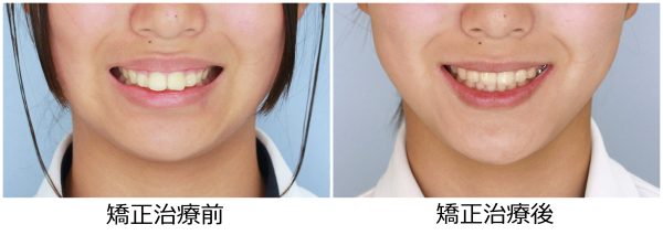 出っ歯治療前後
