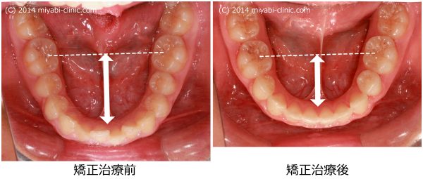 出っ歯治療前後