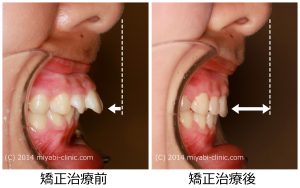 出っ歯治療前後