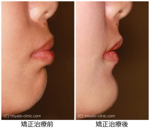 口ゴボ治療前後
