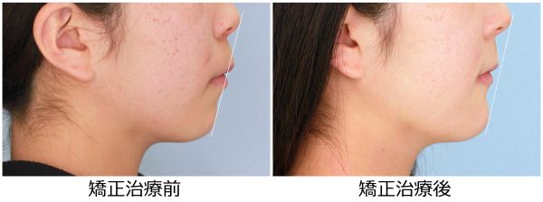 八重歯治療前後