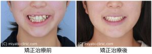 八重歯治療前後
