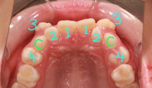 八重歯治療前