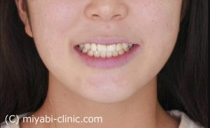八重歯治療後