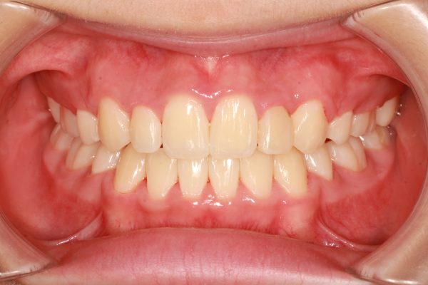 八重歯治療後