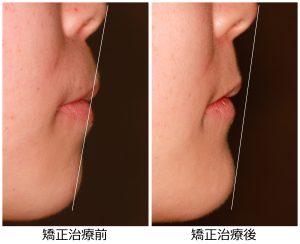 八重歯治療前後