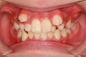 八重歯治療前