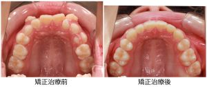 八重歯治療前後