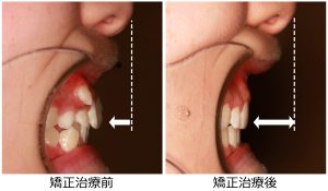 八重歯治療前後
