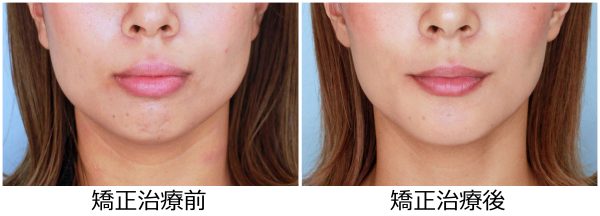 出っ歯治療前後