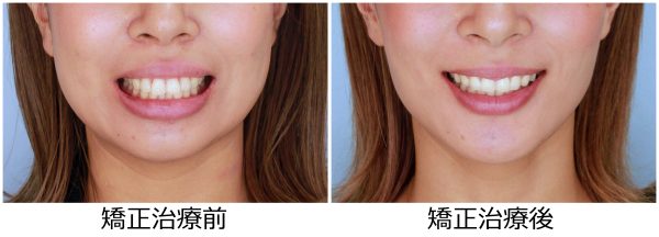 出っ歯治療前後