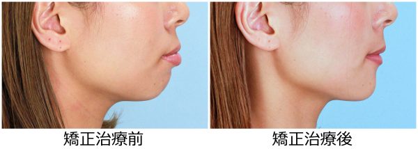 出っ歯治療前後