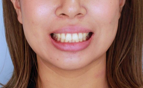出っ歯治療前