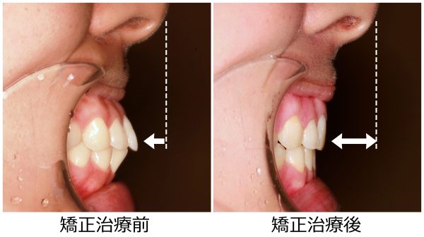 出っ歯治療前後