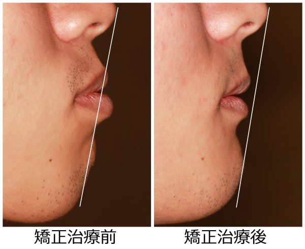 口ゴホ治療前後