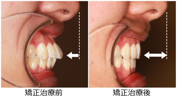口ゴホ治療前後