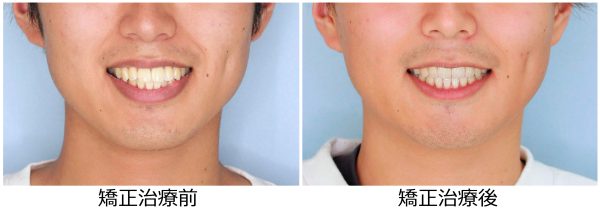 口ゴホ治療前後