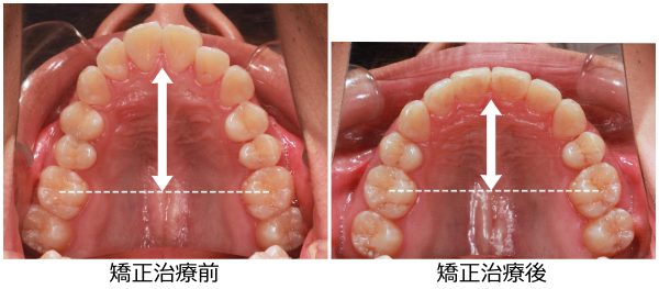 口ゴホ治療前後