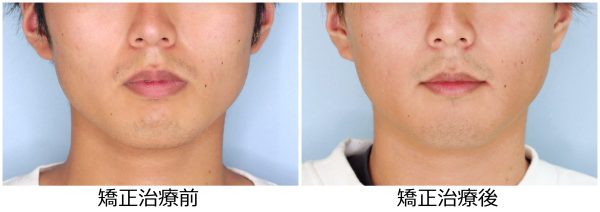 口ゴホ治療前後