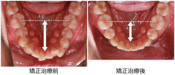 口ゴホ治療前後