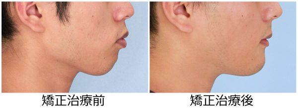 口ゴホ治療前後